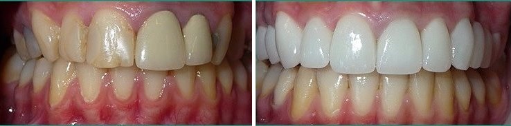 восстановление зубов до и после